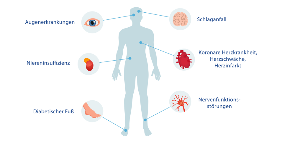 Diabetes mellitus Typ 1 und seine Auswirkungen auf die Augen: Komplikationen und Behandlungsmöglichkeiten